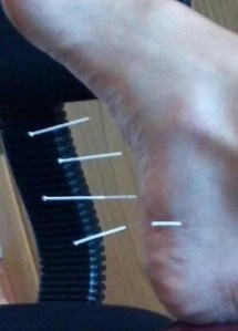 Accupuncture Needles