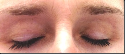 broken blood vessels