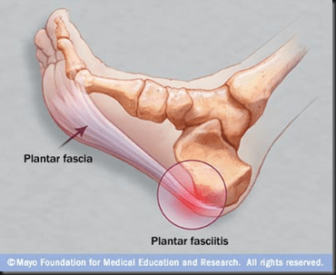 plantar fasciitis